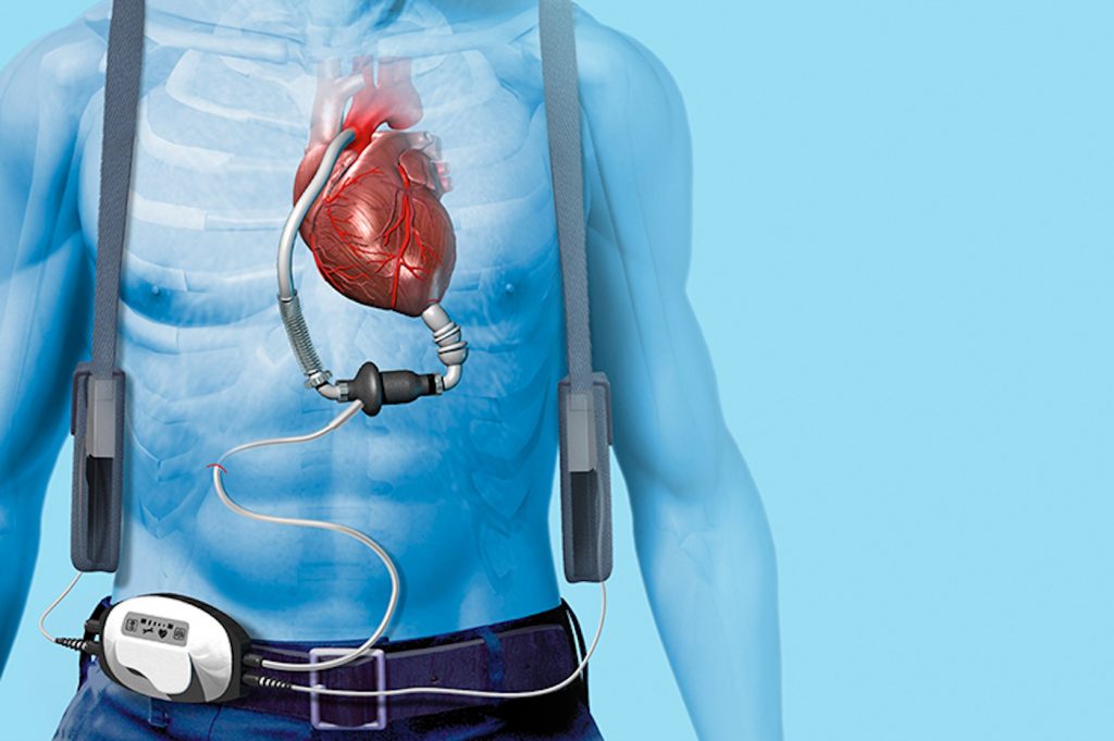 The Ethical Quandary of LVAD Disconnection – Cardiac Vascular News