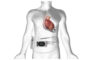 BrioHealth Solutions Begins Patient Enrollment in INNOVATE Trial of BrioVAD® System for Advanced Heart Failure