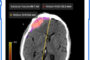 Viz.ai Receives First and Only FDA 510(k) Clearance for Subdural Measurements