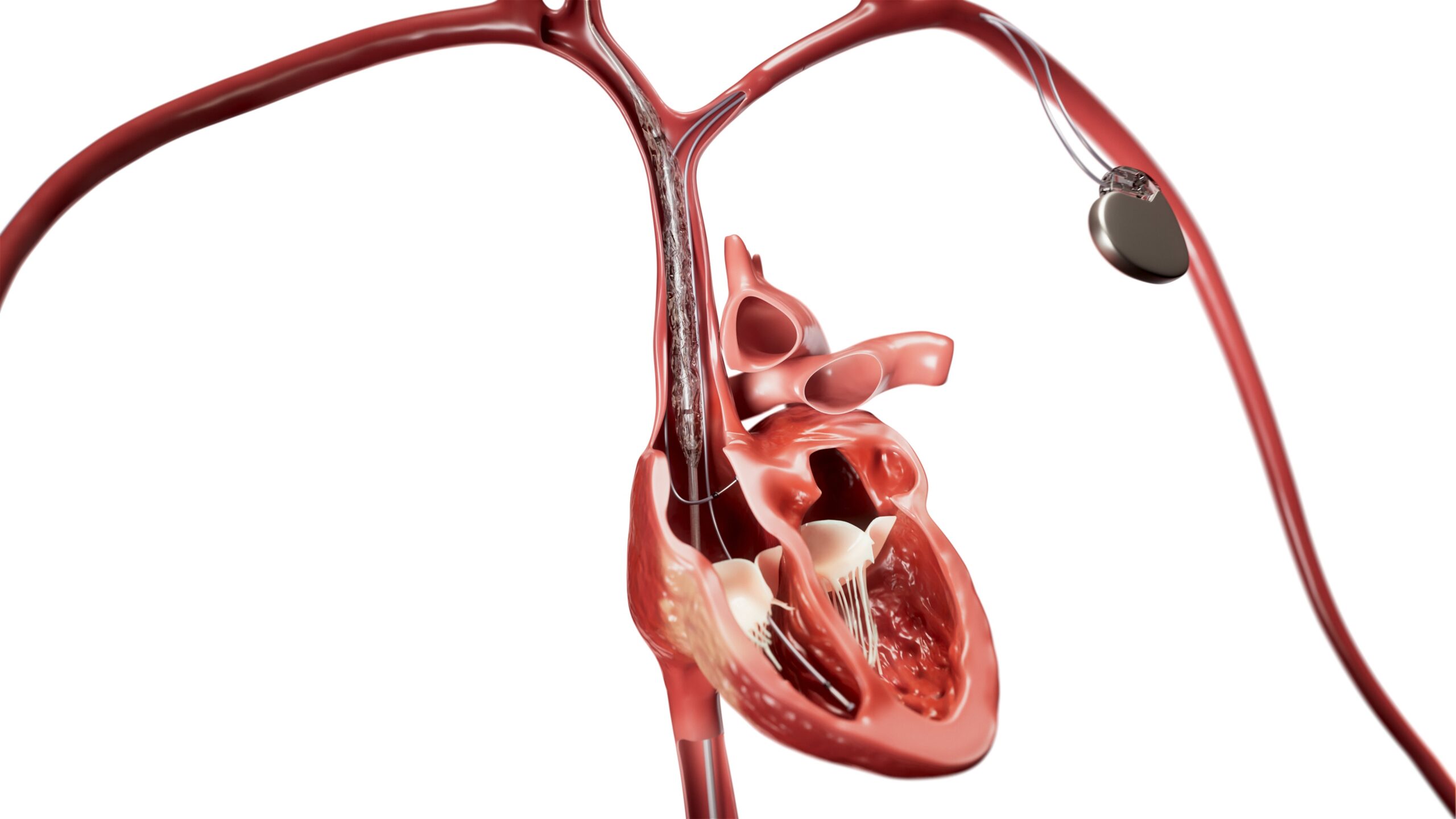Clinical illustration of the Philips Bridge Plus balloon in use