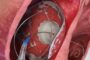 TruLeaf Medical, a fully-owned subsidiary of Allmed Solutions successfully Completed the Second Stage of valve implantation in two Additional Patients