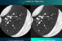 Subtle Medical Receives FDA Clearance for SubtleHD™(CT), Expanding AI-Powered Image Enhancement into CT Imaging