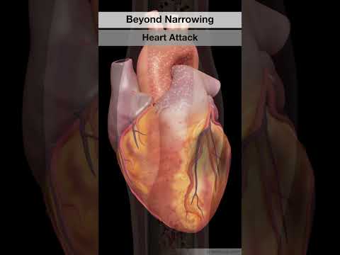 Watch now: Hidden Risks of Coronary Artery Disease Watch now: Hidden Risks of Coronary Artery Disease