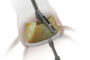 Medtronic Announces Strategic Investment in Pi-Cardia to Accelerate Innovation for Complex TAVR